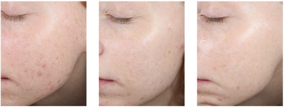 peeling al retinolo